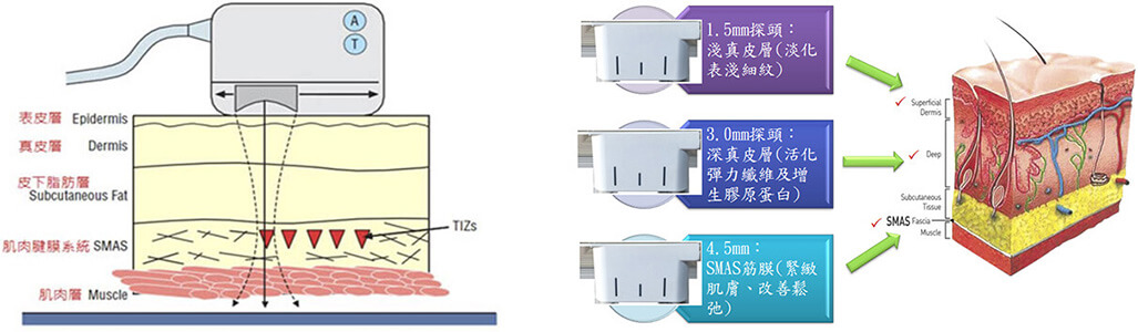 音波拉提