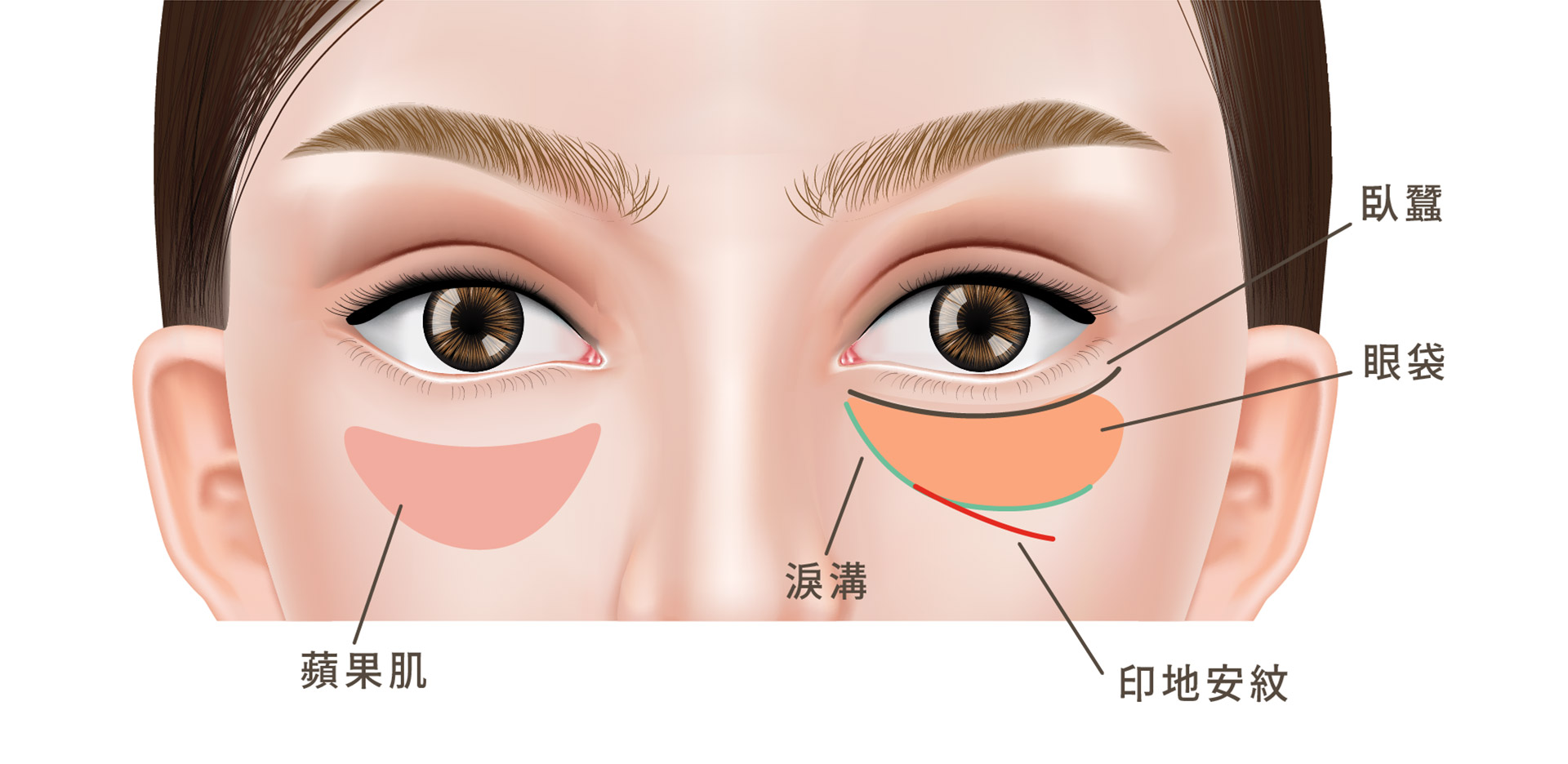 下眼瞼極細切口、移除多餘脂肪團、隱痕完成