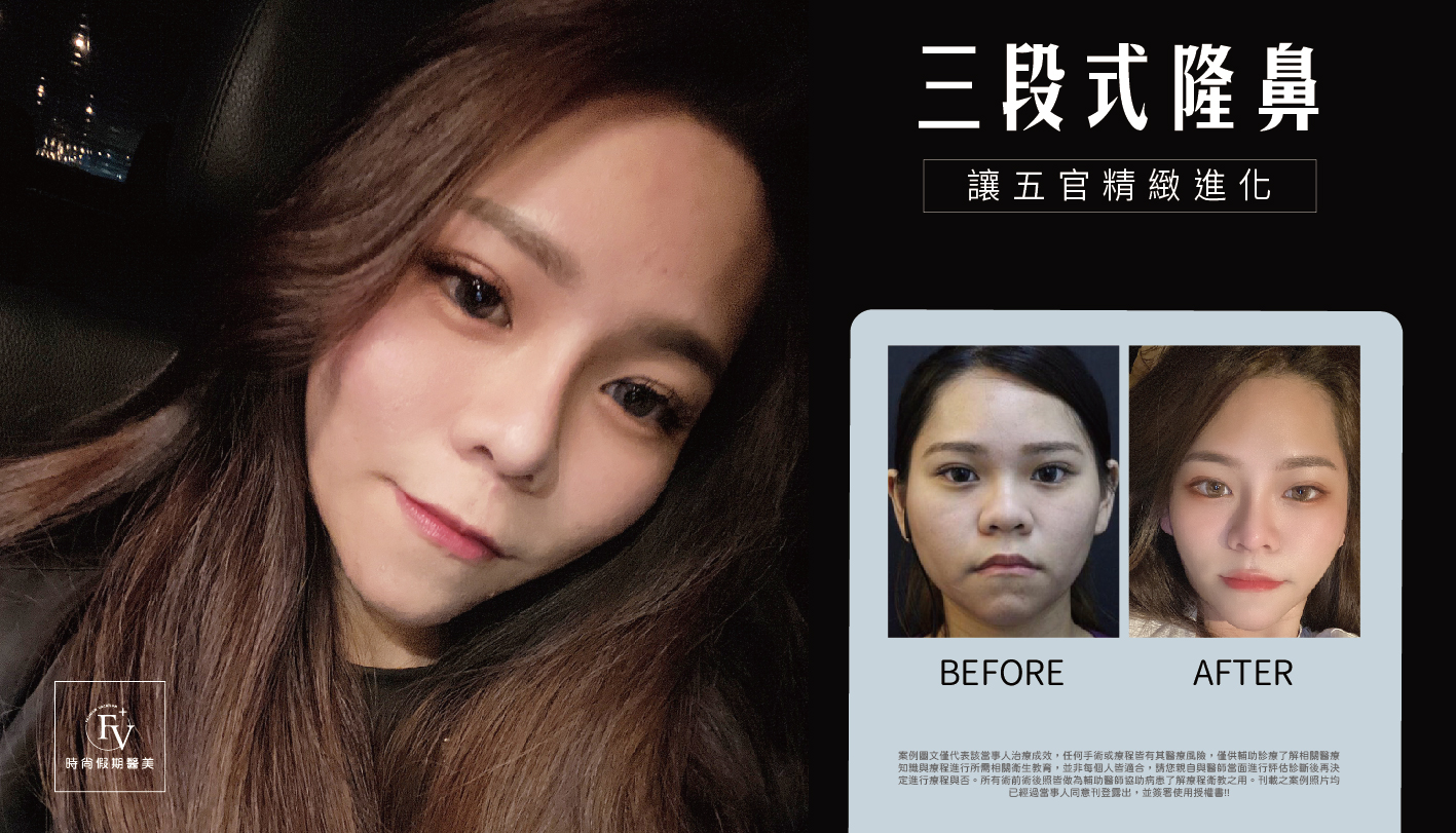 隆鼻-12.jpg