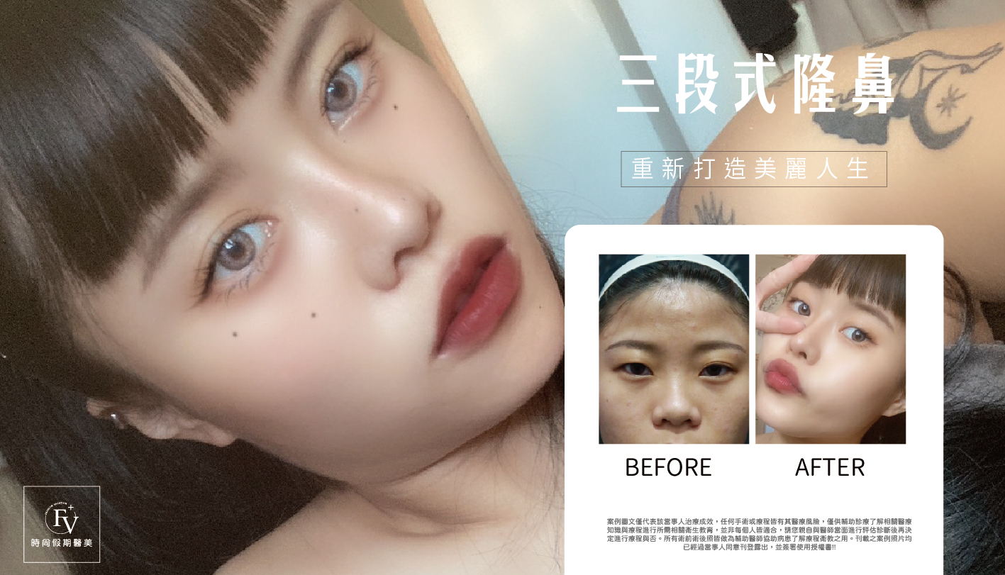 隆鼻-13.jpg