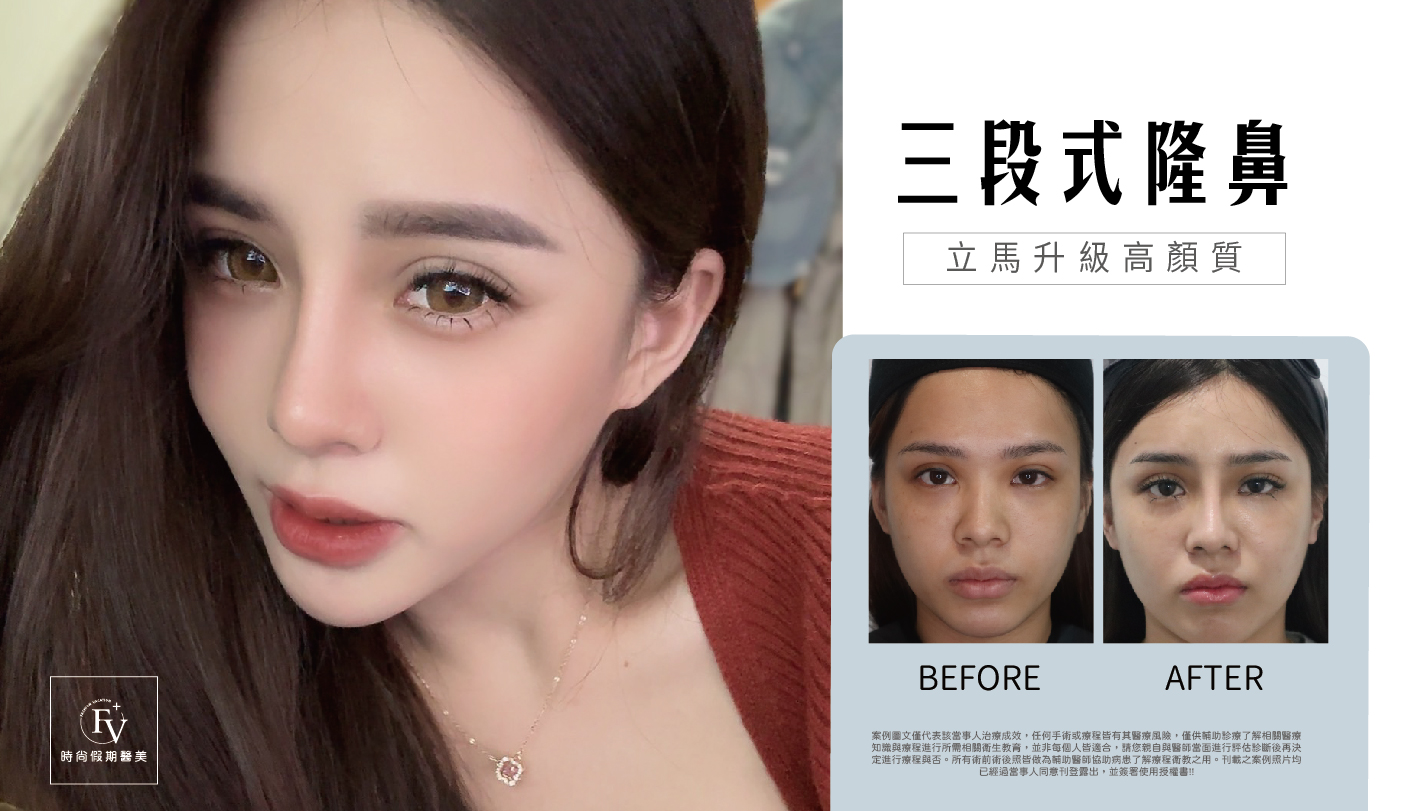隆鼻-14.jpg